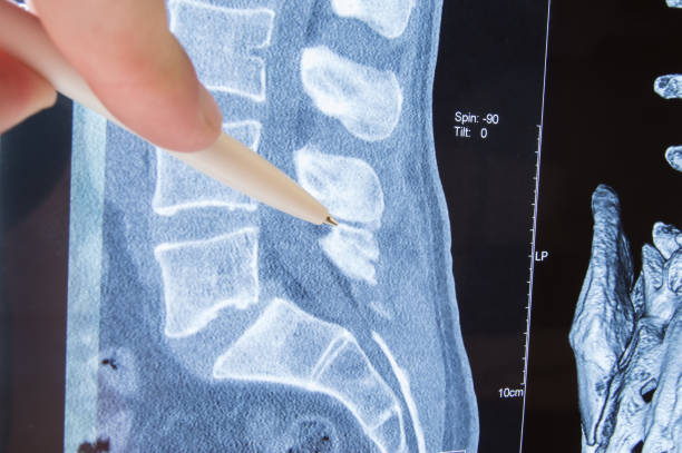 Lumbar stenosis technique talk.